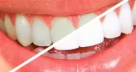 Best Teeth Whitening Services Melbourne, Prahran, Windsor & South Yarra